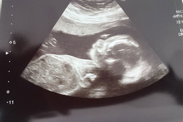 ultrasound image from a 20-week pregnancy scan, showing a side view of the baby in the womb