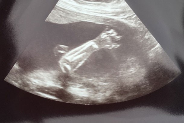 20 week scan showing baby waving arm