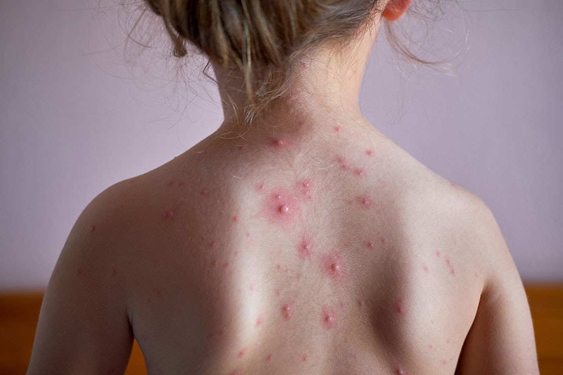 chickenpox spots