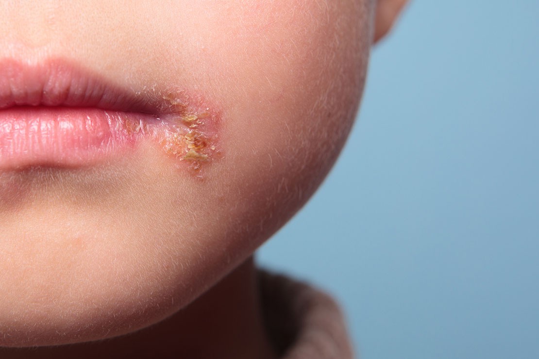 child with cold sore blister