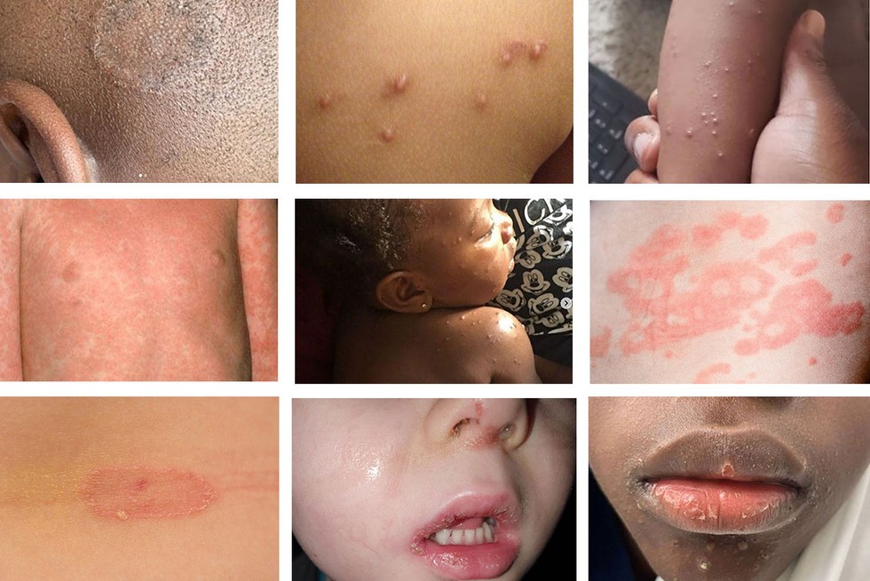 children spots and rashes