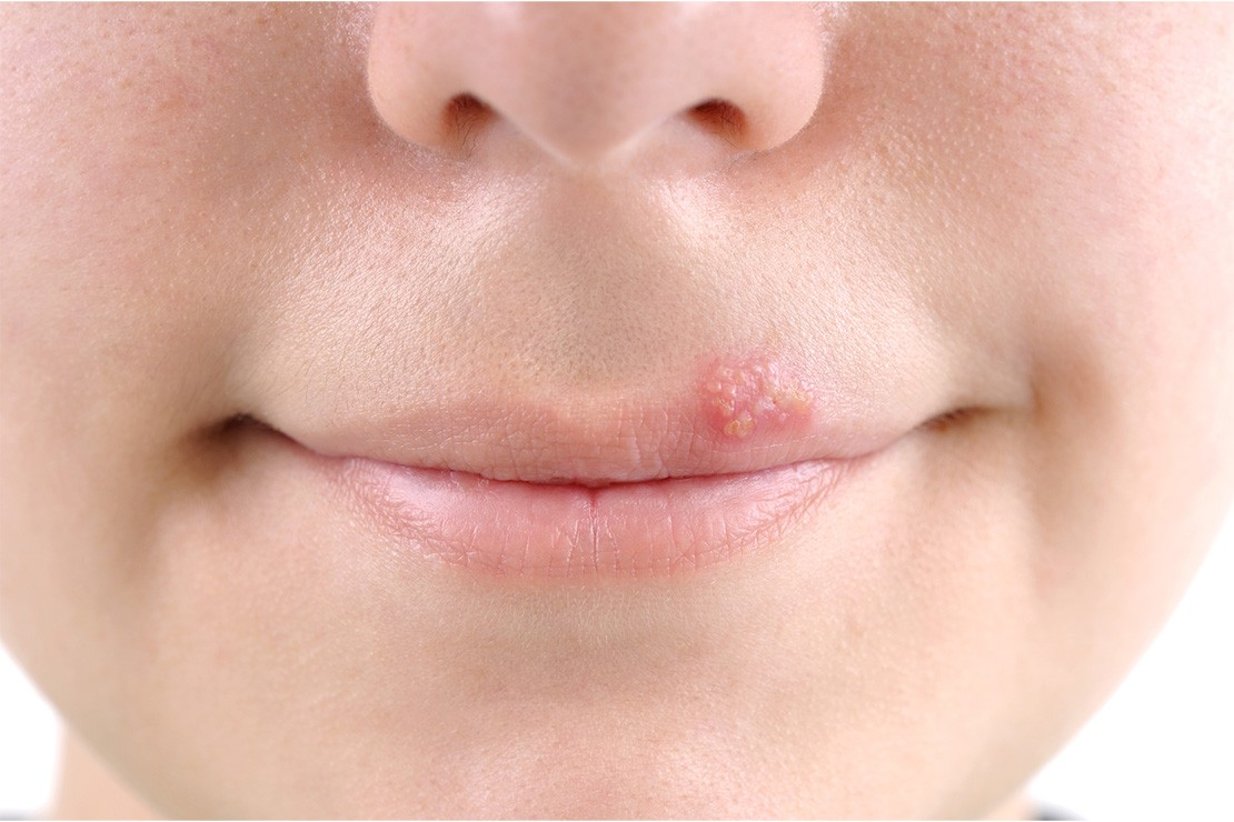Child with cold sore