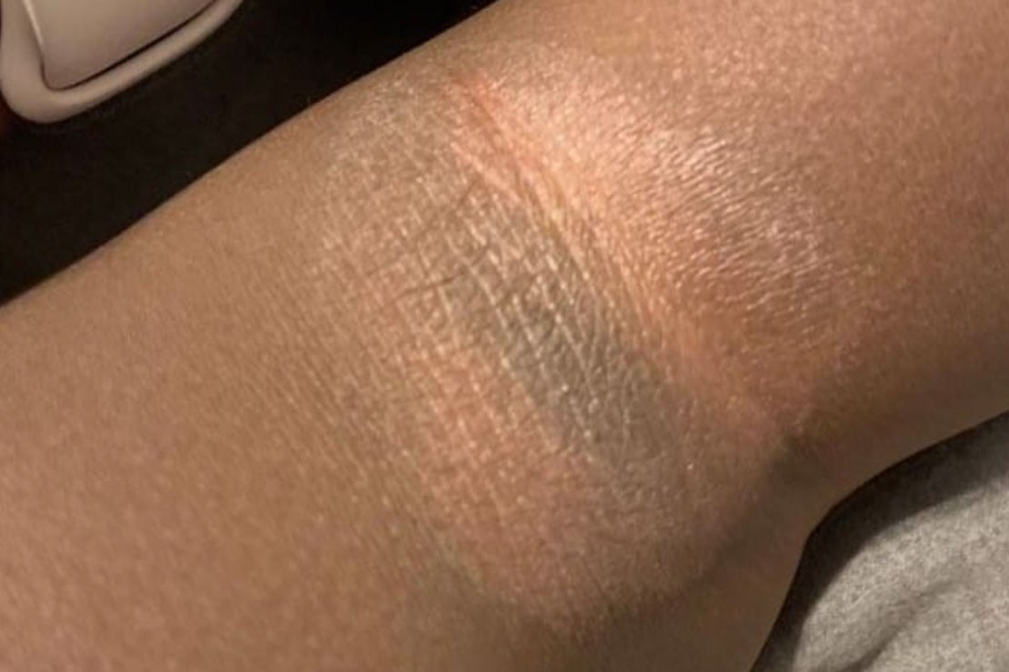 eczema black skin