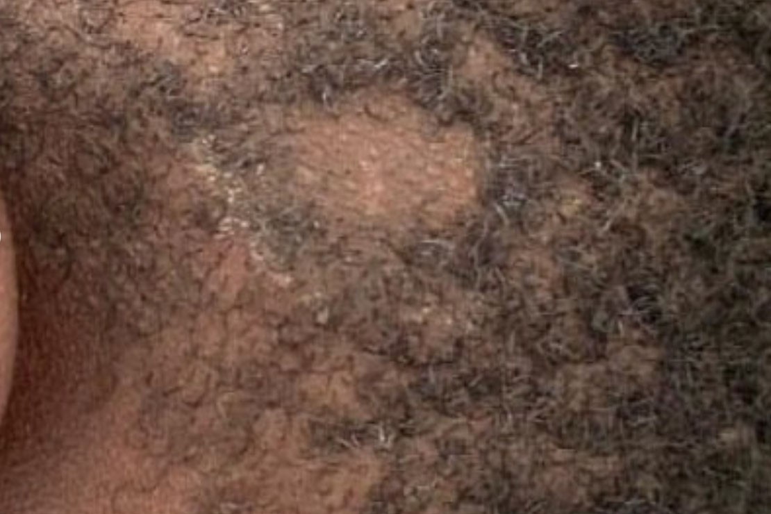 ringworm black skin