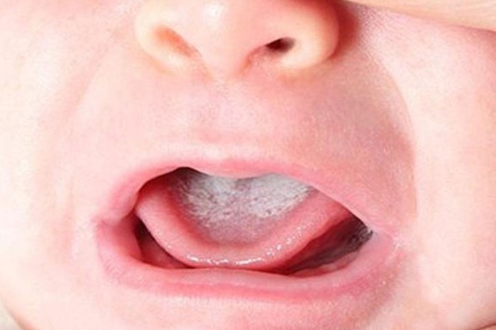 oral thrush on baby's tongue