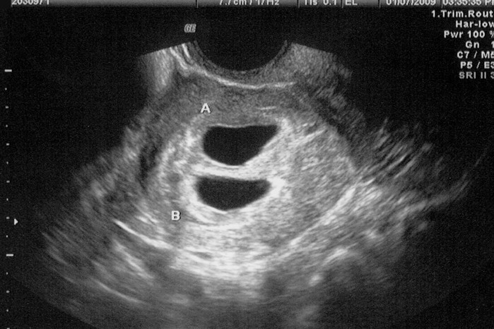 ultrasound scan of a twin pregnancy